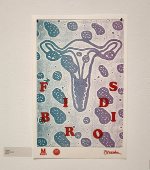 Fibroids